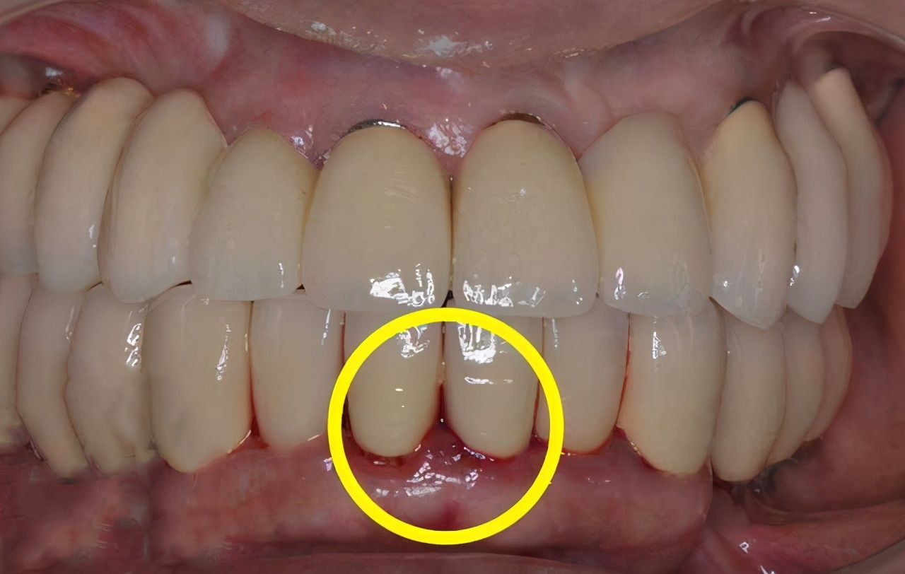 塞牙是小事？不，很可能是病，会掉牙