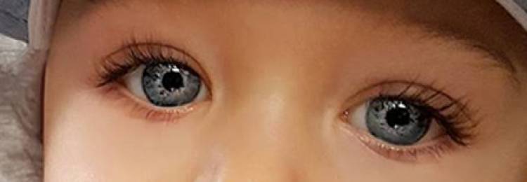 8个月宝宝倒睫严重怎么办,宝宝倒睫怎么治疗成功