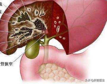 号称不死的癌症有人因它生不如死,前列腺炎为什么被称为不死的癌症