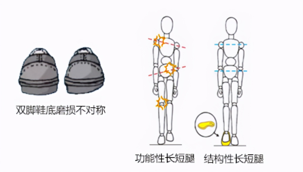 走路费鞋后跟,如何通过鞋底判断走路姿势