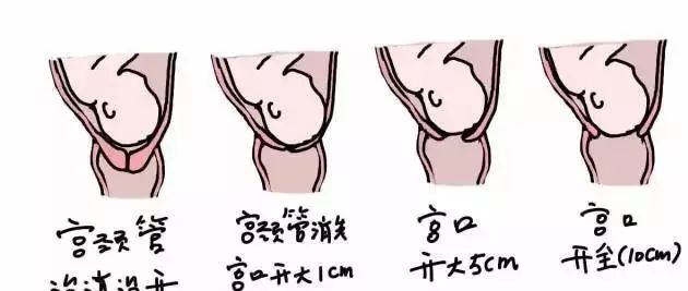 顺产宫口开几指才可以生,宫口开了2指肚子不痛多久生