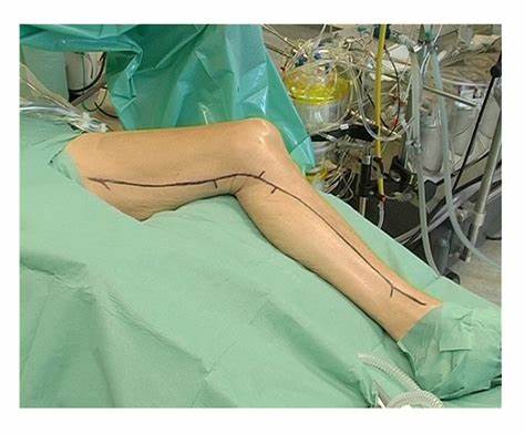 静脉曲张术前及术后注意事项,静脉曲张术前有哪些禁忌