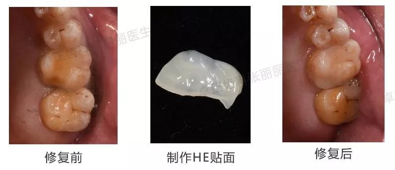 牙齿楔状缺损修复图片,牙齿楔状缺损修复大概多少钱