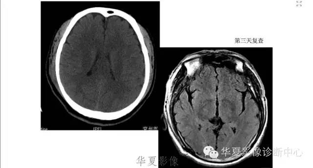 一文读懂颅内胆脂瘤,一文看懂背后的真相