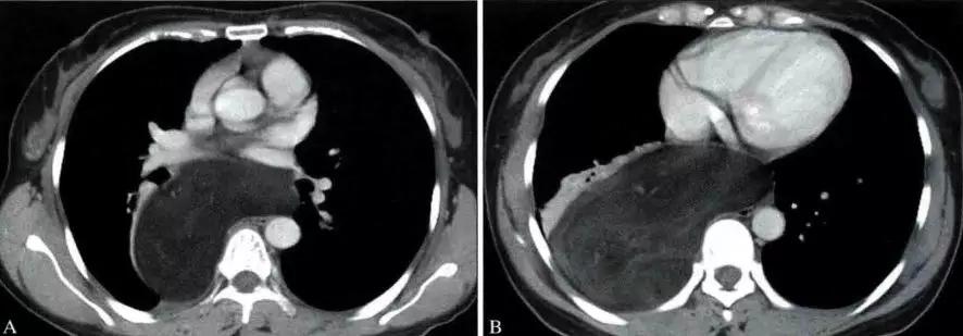 前上纵隔高密度影考虑胸腺未退化,肺纵隔胸腺结节12mm看什么科