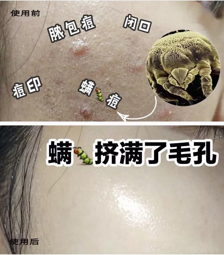 专治螨虫的洗面奶,螨虫专用洁面乳