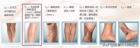 下肢静脉曲张教你正确防治,下肢静脉曲张血管外科