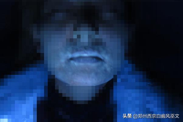 白癜风治疗前后对比图,白癜风治疗中为什么白斑更加白呢