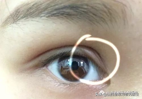 5000元做双眼皮惨不忍睹,哪种双眼皮性价比高