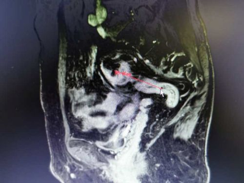 结直肠癌肝转移还能手术吗,结直肠癌肝转移的介入治疗