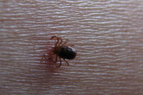 蜱虫咬人后怎么治疗处理,蜱虫咬人后怎么弄下来