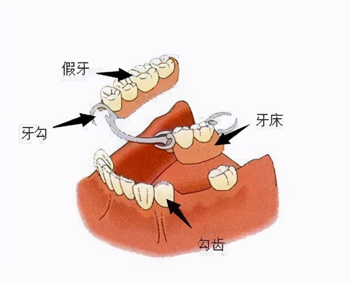 戴假牙的正确方法及注意事项,不懂保护牙齿将来会怎么样