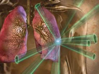 胸部放射治疗并发症,胸部纵隔肿瘤放疗