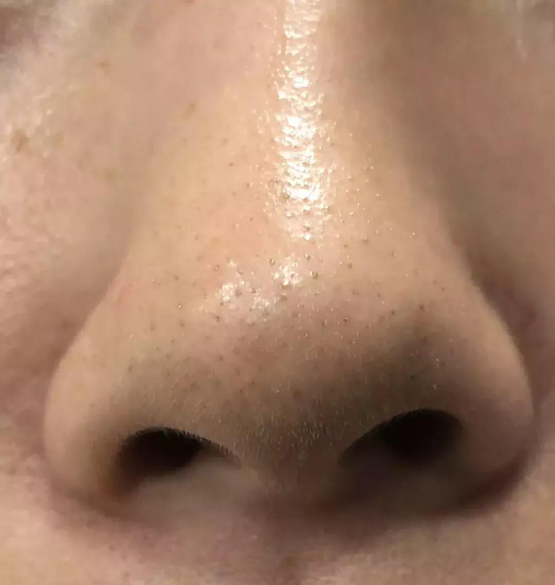 洗脸清洗黑头,洗脸清洁去粉刺