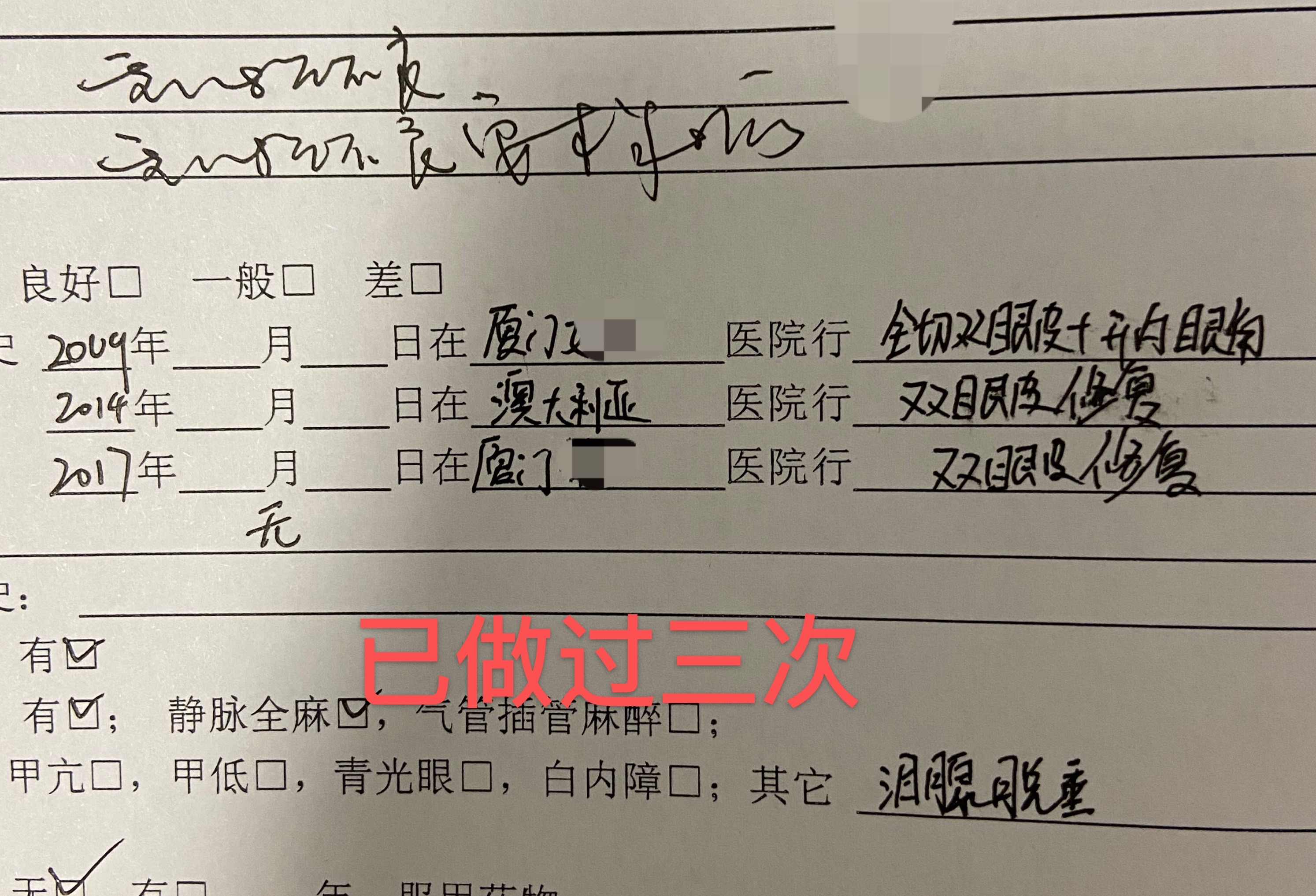 高难度修复双眼皮宽改窄恢复期,高难度双眼皮修复案例