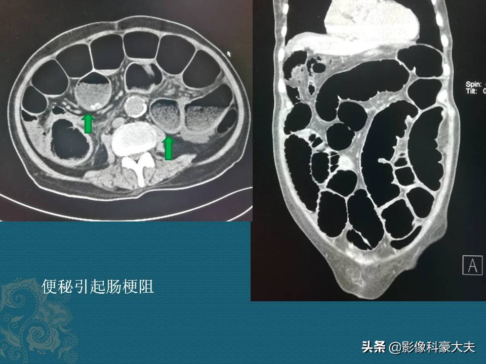 小孩便秘去医院洗肠全过程,六岁孩子五天没排便了怎么办