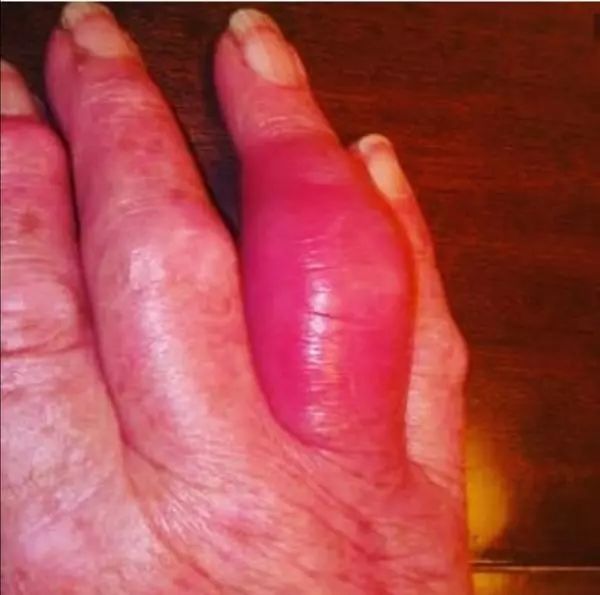 痛风真的有那么可怕吗,痛风到底有多可怕看完全都明白了