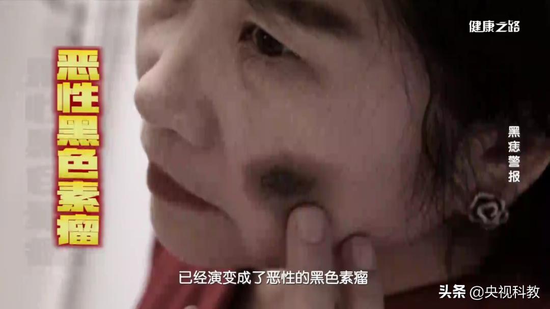 身上的黑痣有癌变的风险吗,身上长黑痣怎样防止恶变