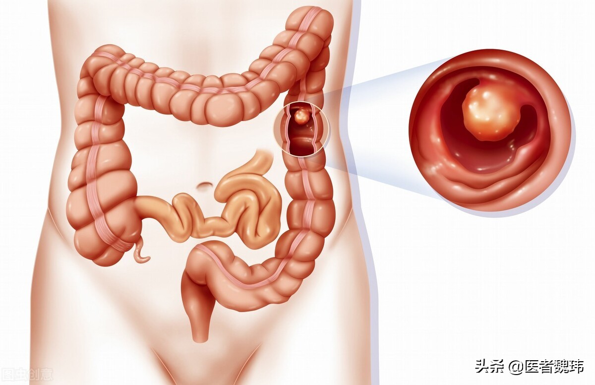 读病理报告,病理诊断结果是息肉