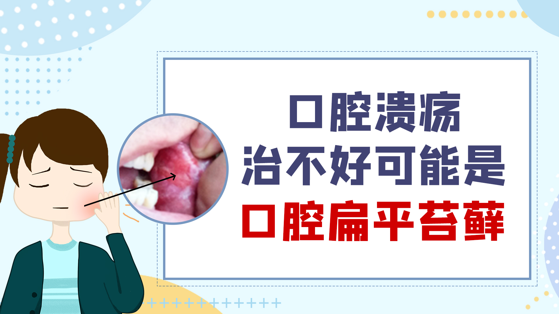 口腔扁平苔藓溃疡能不能愈合,口腔扁平苔藓溃疡能治愈吗