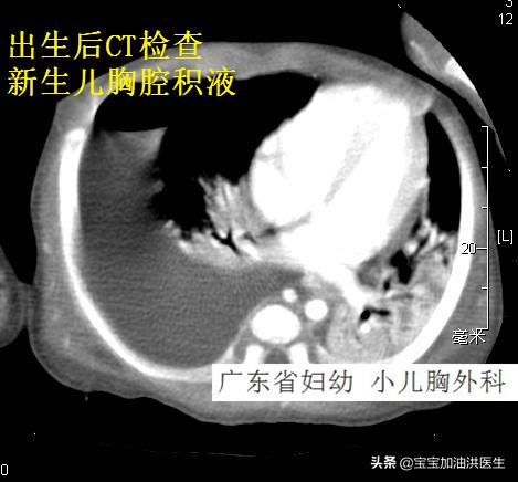 还没生就溢乳是什么导致的,还没生就流虚汗