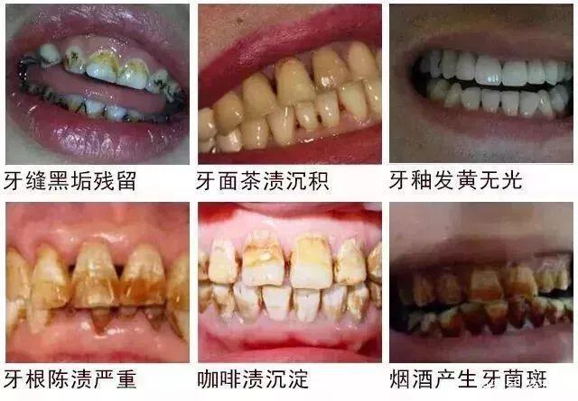 李佳琦牙齿怎么变白的,李佳琦怎么变白的