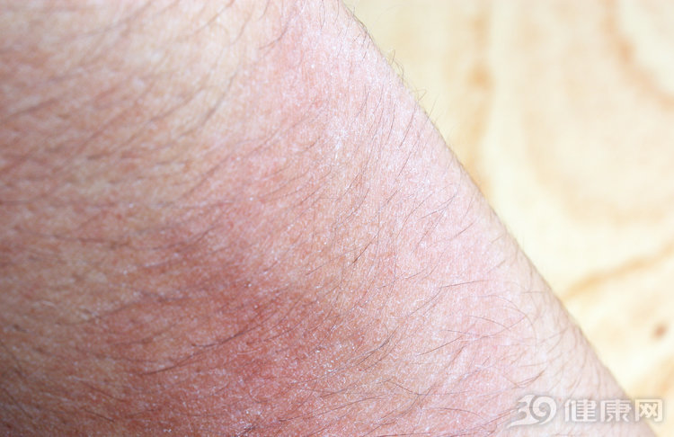 中医治疗湿疹效果最好的方法,中医怎么治疗湿疹最有效