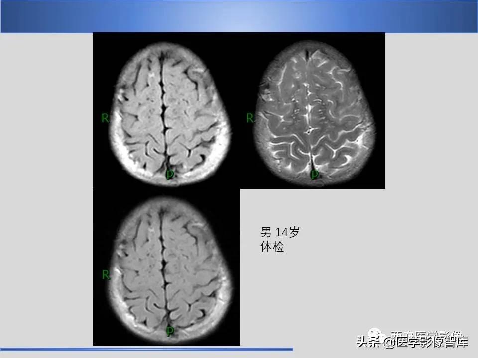 vr间隙概念,vr间隙需要做什么检查