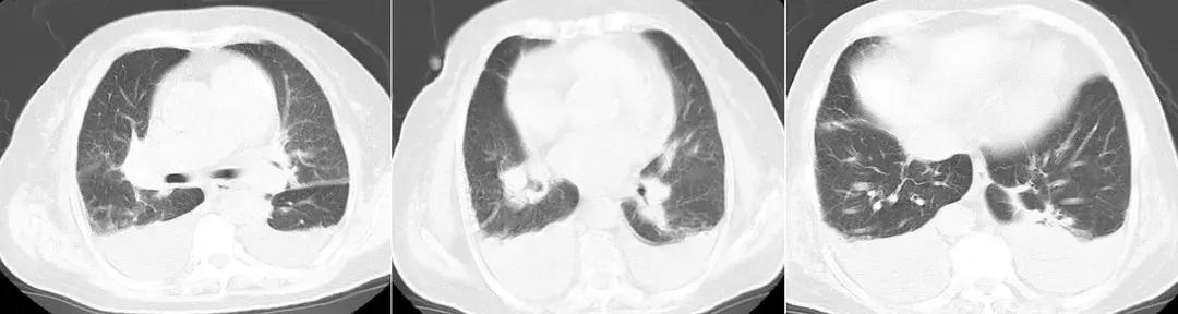 病人无法脱离插管呼吸机,病人无法脱离呼吸机如何转院