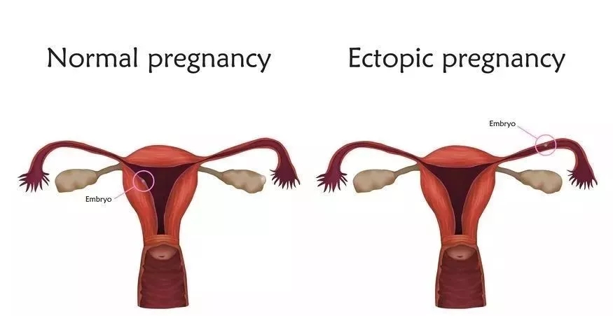 罕见！女子腹痛，扬州医生发现孕囊竟“跑”到这里！