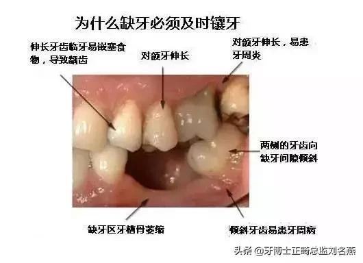 缺牙做修补和烤瓷哪个好,缺牙修复有几种方法