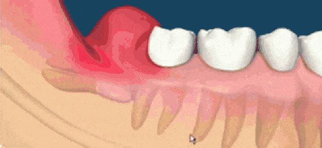 拔智齿真实过程无切口,拔智齿真实体验