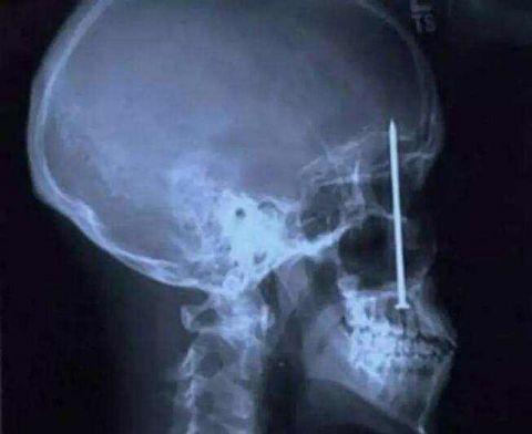 不作死就不会死，看看这些被人类搞进身体里的异物