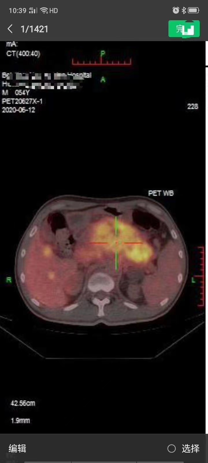 胰腺癌腹膜后多发淋巴转移严重吗,胰腺癌肝内多发转移可以放疗吗