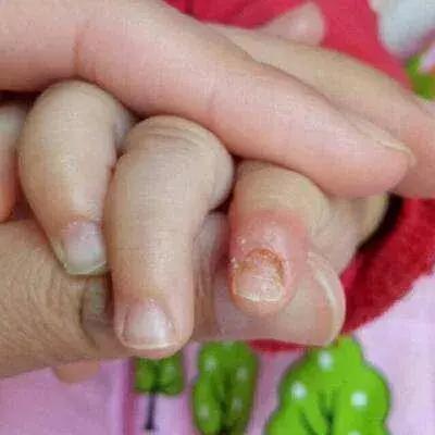 科普|宝宝指甲凹凸不平怎么办,营养补给和卫生习惯能解决!