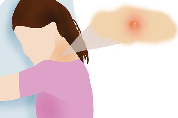 脖子腋下长小肉粒用什么药,脖子腋窝上长小肉粒可以剪掉吗