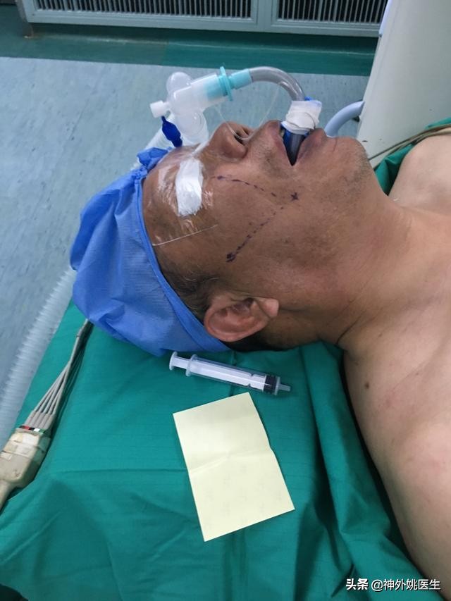 三叉神经痛微创治疗方法,超微创定向修复三叉神经