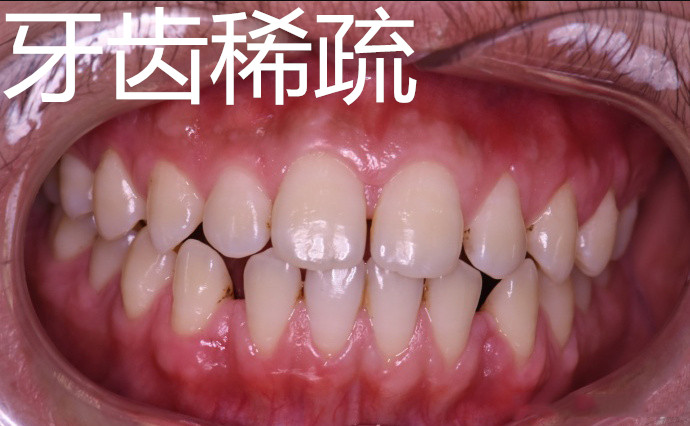 30岁了还可以做牙齿矫正吗,30岁还可以做牙齿矫正吗