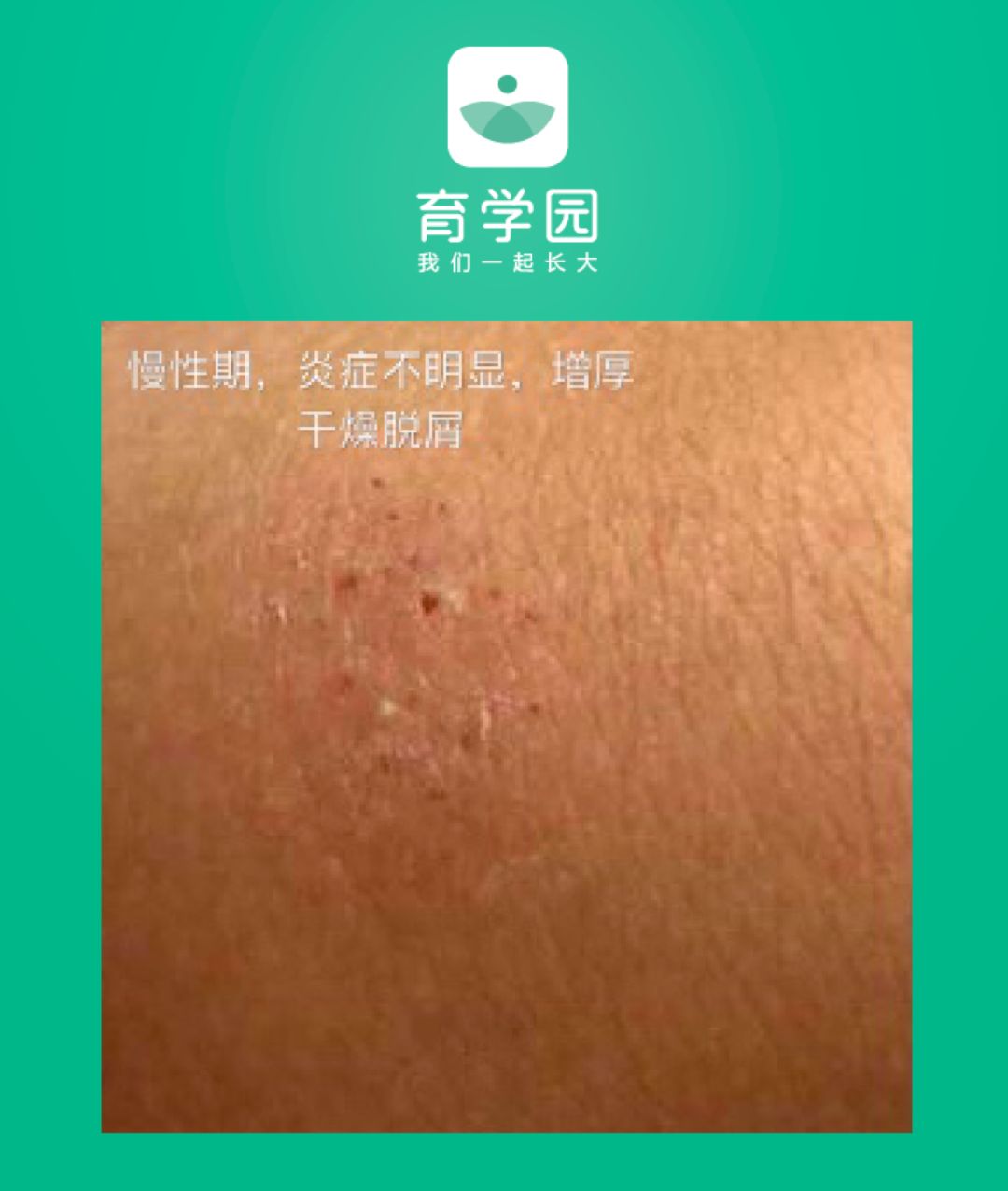 宝宝皮肤发红疹怎么办,宝宝皮肤发红粗糙还痒怎么回事