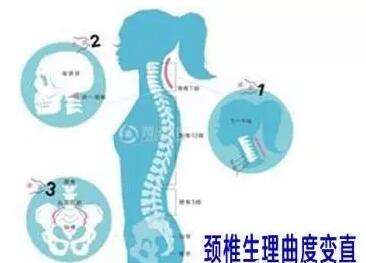 颈椎骨质增生伴曲度变直怎么回事,颈椎增生曲度变直会引起低压高吗