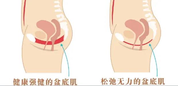 子宫全切恢复正常以后注意什么,腹腔镜子宫切除术后恢复注意事项