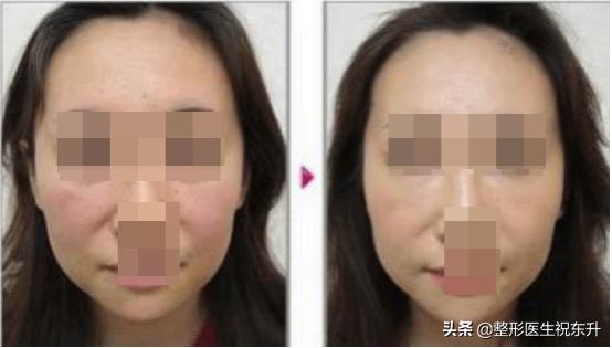 40岁做拉皮手术会年轻几岁,年龄大了做拉皮手术图片