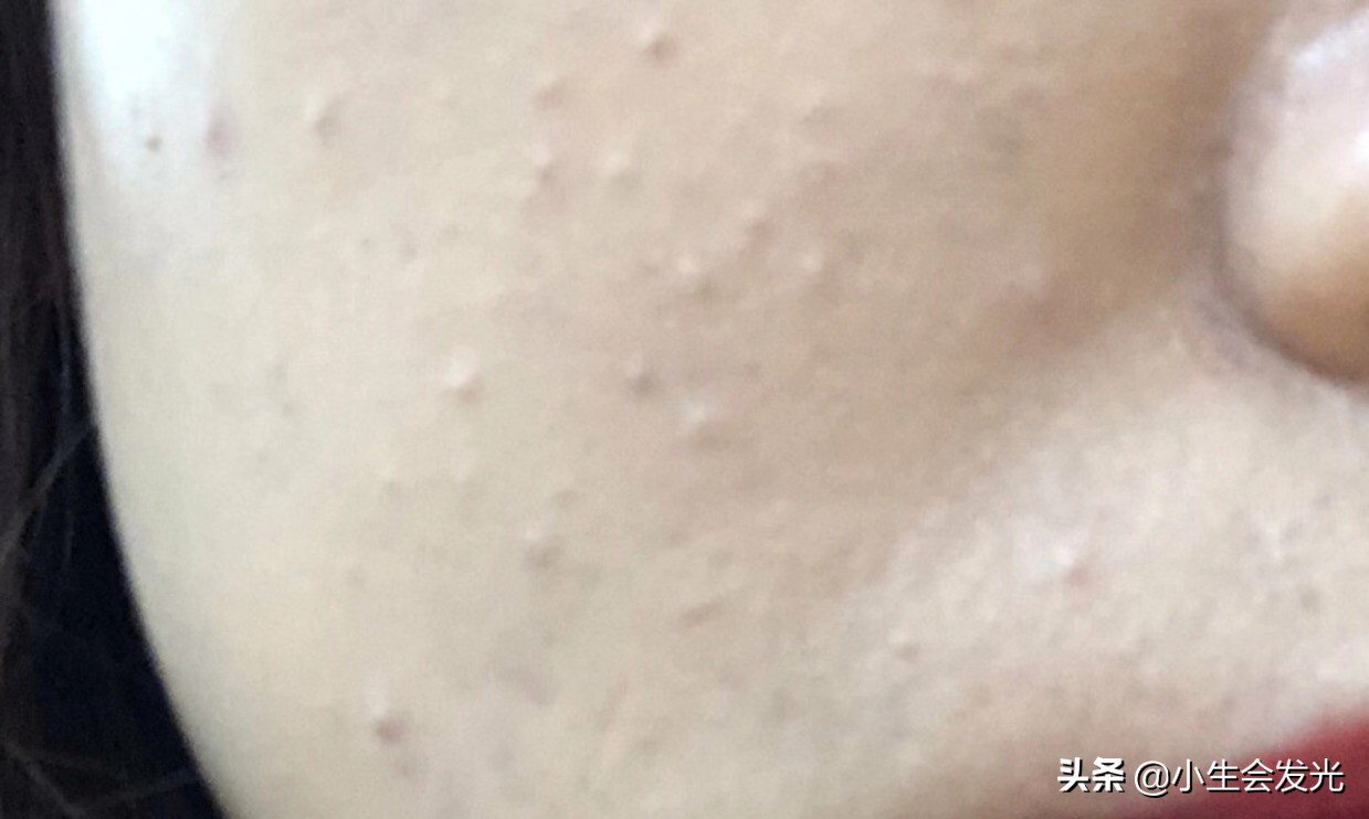 闭合性闭口怎么形成的,闭口怎么成痘痘了