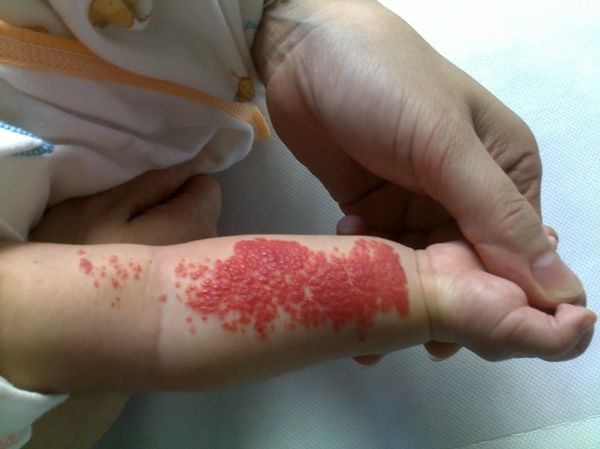 血管瘤鲜红斑痣是什么原因造成的,鲜红斑痣是不是比血管瘤厉害难治