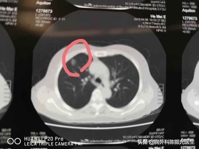 肺结节手术要做活检吗,肺结节多大需要手术干预治疗