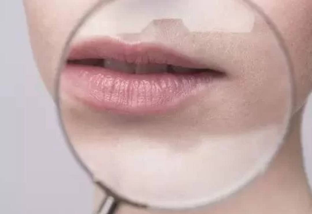 嘴唇有唇纹该如何淡化,嘴唇干唇纹深怎么改善