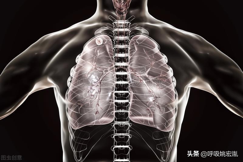 肺结节会形成肺癌吗,肺结节是怎么形成的能引起病变吗