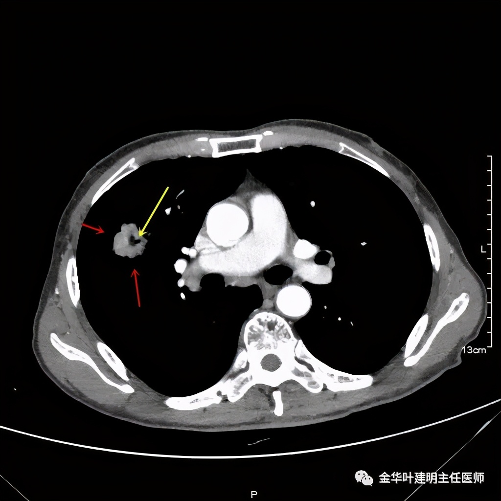 得了肺癌做肺部穿刺有影响吗,肺部穿刺可以确诊肺癌吗