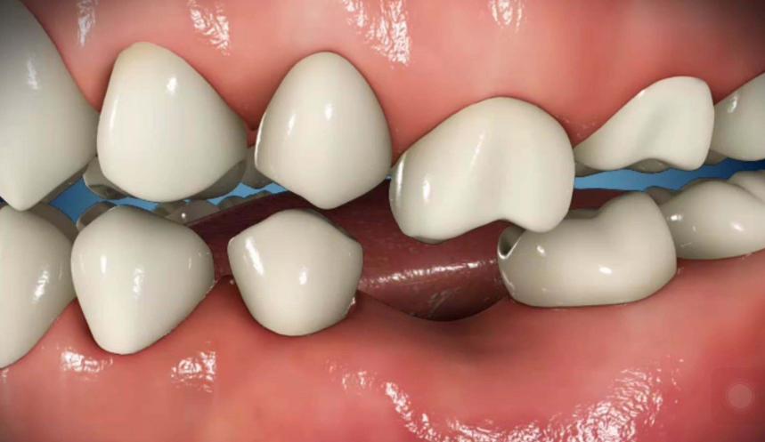 同样是补牙,为什么差距那么大?不同的补牙材料到底该怎么选?