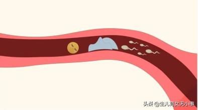 输卵管堵了和积水到底能不能通,输卵管不是完全阻塞远端迂曲
